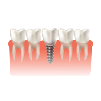Dental Implants Illustration