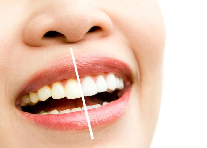 Teeth Whitening & Polishing