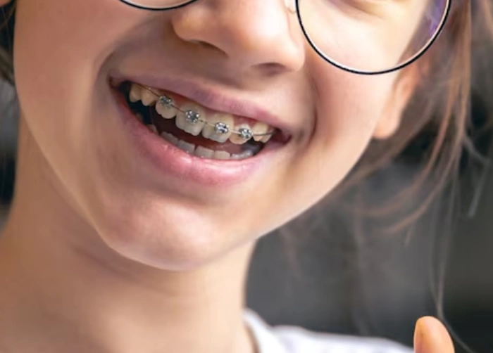 Braces Treatment