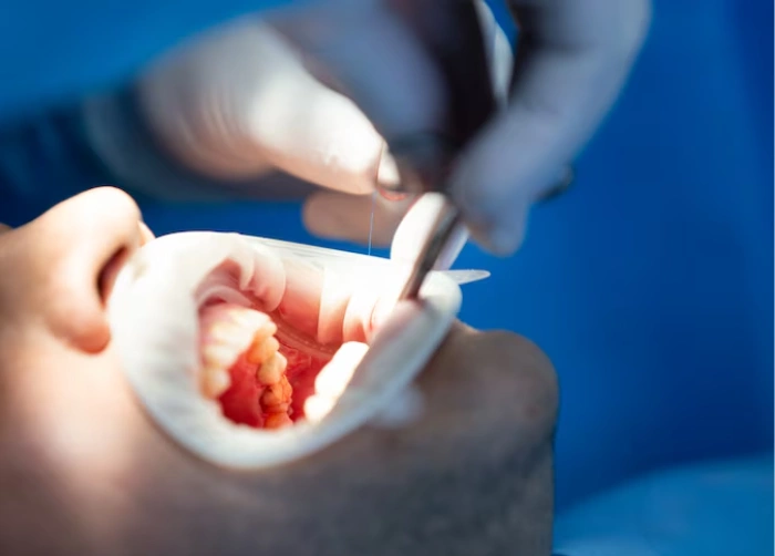 Root Canal Treatment