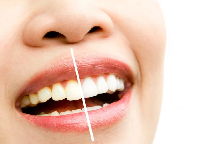 Teeth Whitening