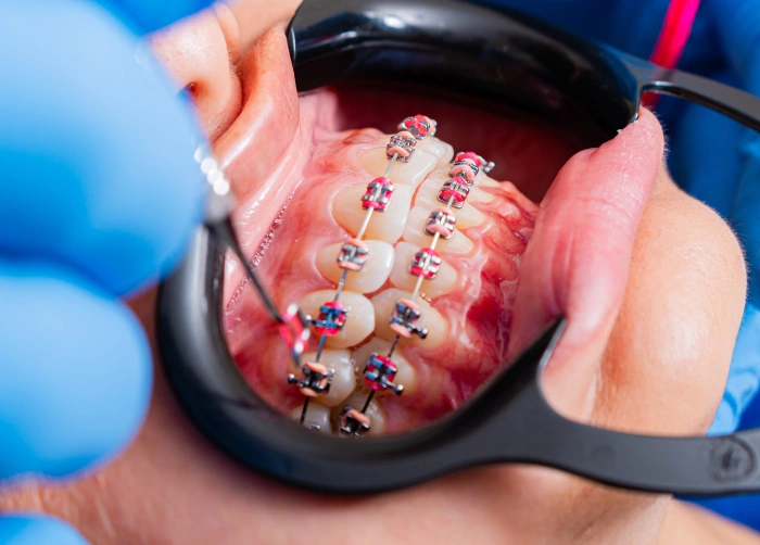 Clear Aligners