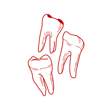 Wisdom Tooth Extraction Illustration